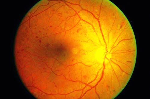 retinopatia diabetica