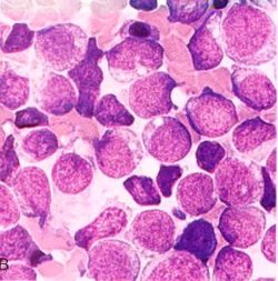 Udine, un evento innovativo sulla Leucemia Mieloide Cronica