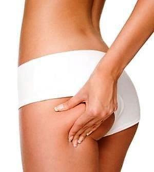 cosce molli e cellulite