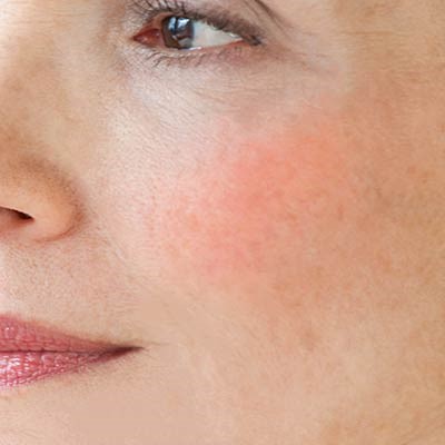 Sensiderm di Dermophisiologique, tre risposte per la bellezza della pelle sensibile