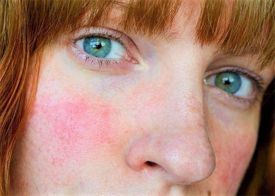 rosacea