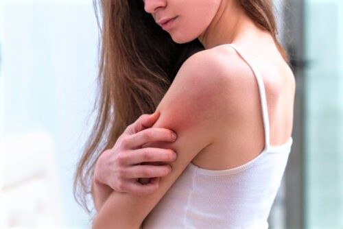Dermatite atopica: più attenzioni con il freddo