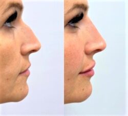 Medicina Estetica, i cinque trend del 2021: filler per naso, mandibola e labbra, botulino e “foxy eyes”