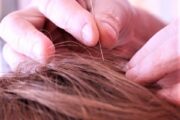 I  mal di testa? Toglieteli dalla testa con l’agopuntura
