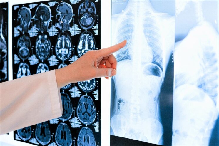 Roche – Nuove prospettive nel trattamento del tumore al polmone non a piccole cellule in fase iniziale: arriva in Italia una nuova indicazione di atezolizumab